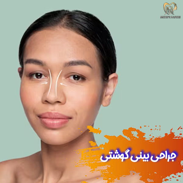 جراحی بینی گوشتی - دکتر مهدی صابری