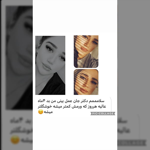 رضایت زیباجو از بهترین جراح بینی