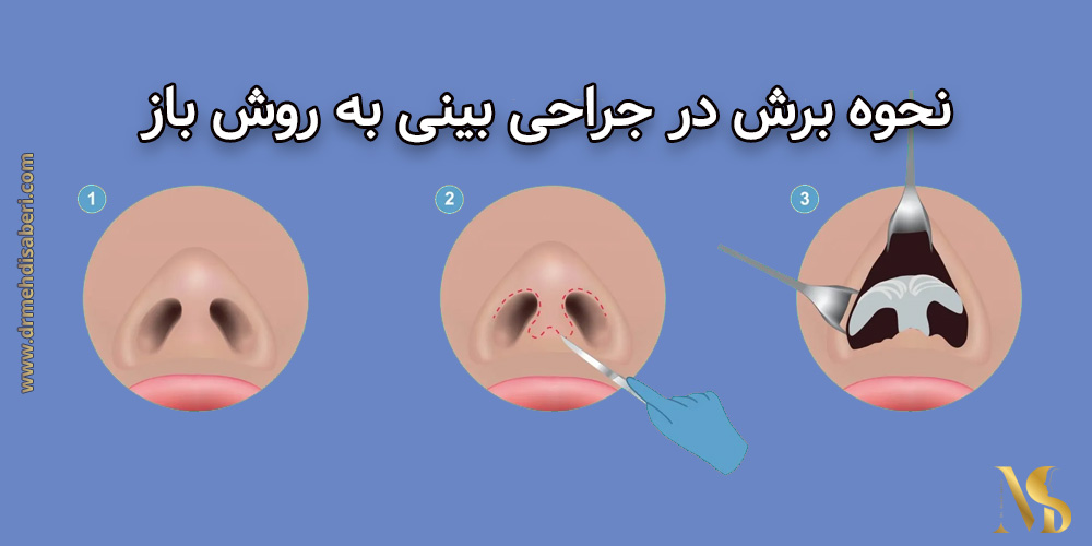 جراحی بینی به روش باز