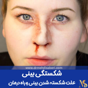 شکستگی بینی