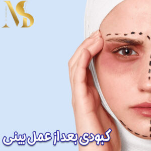 کبودی بعد از جراحی بینی