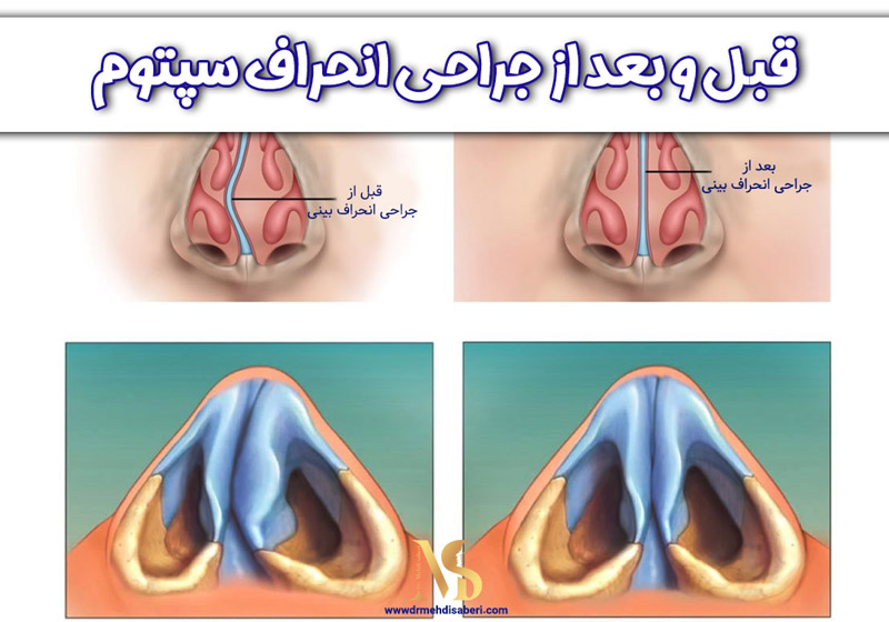 عکس قبل و بعد عمل انحراف بینی