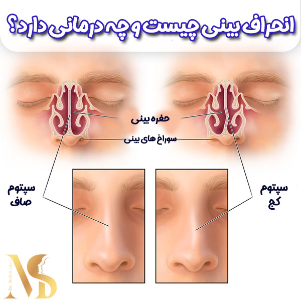 انحراف بینی