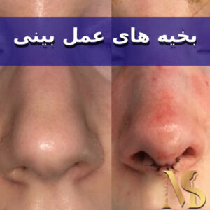 بخیه های عمل بینی