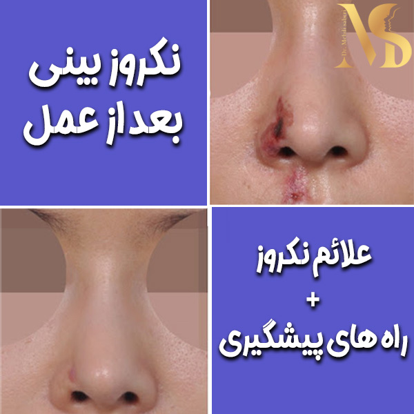 عکس نکروز بینی