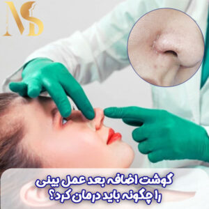 گوشت اضافه بعد عمل بینی