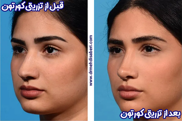 عکس قبل و بعد تزریق کورتون به بینی