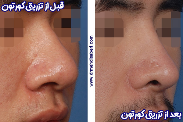 عکس قبل و بعد تزریق کورتون به بینی