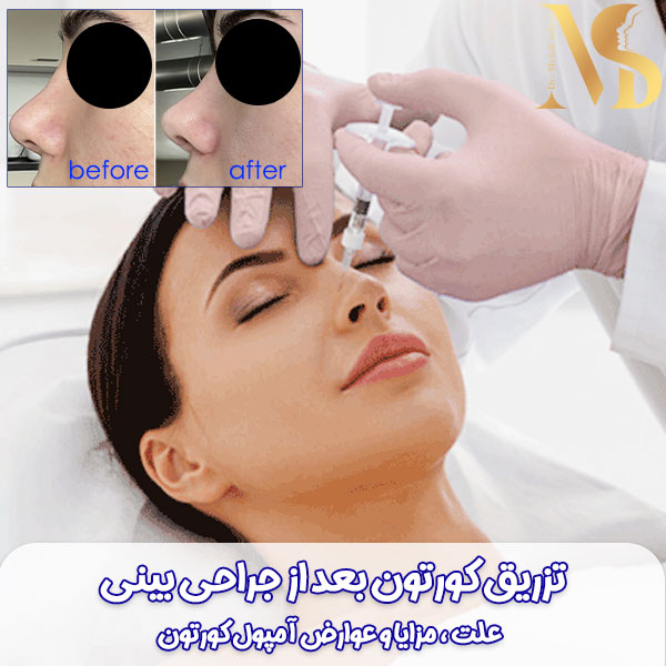 تزریق کورتون بعد از جراحی بینی