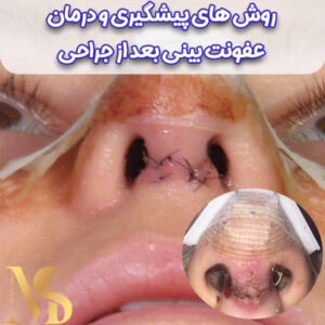 عکس عفونت بینی عمل شده