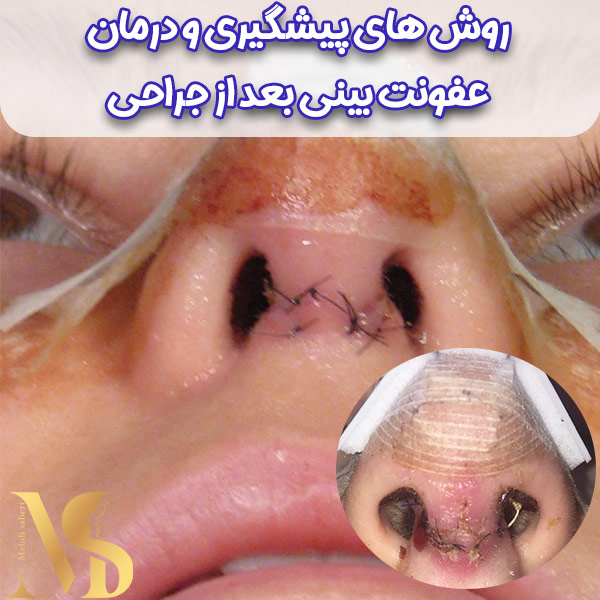 عکس عفونت بینی عمل شده