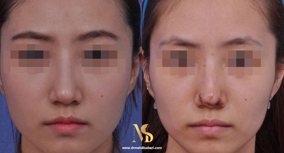 تصویر نکروز بینی