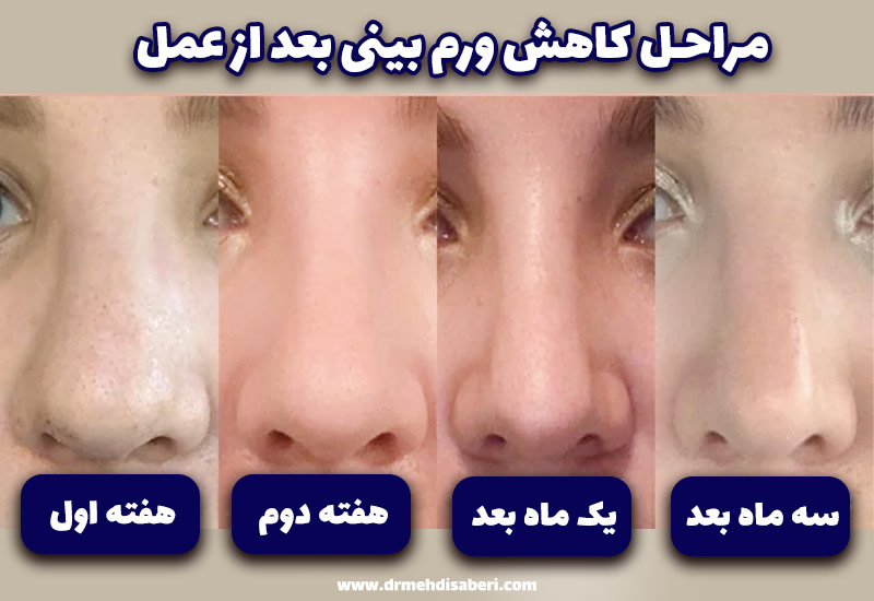 عکس ورم بینی بعد از عمل