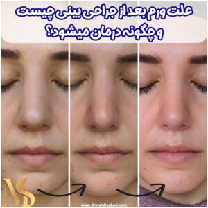 ورم بعد از جراحی بینی