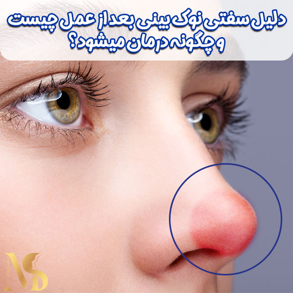 سفتی نوک بینی بعد از عمل