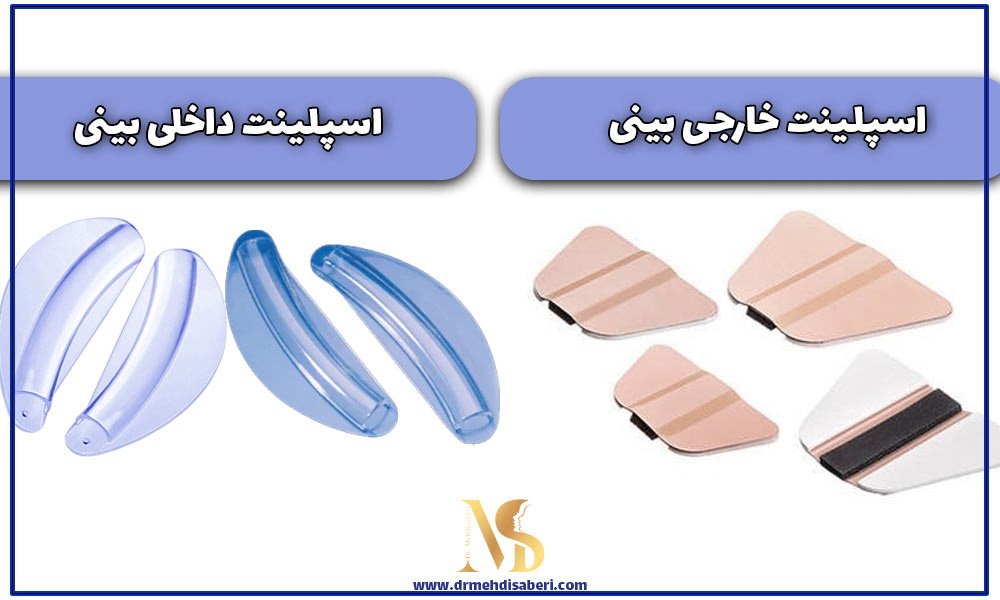 عکس انواع اسپلینت بینی