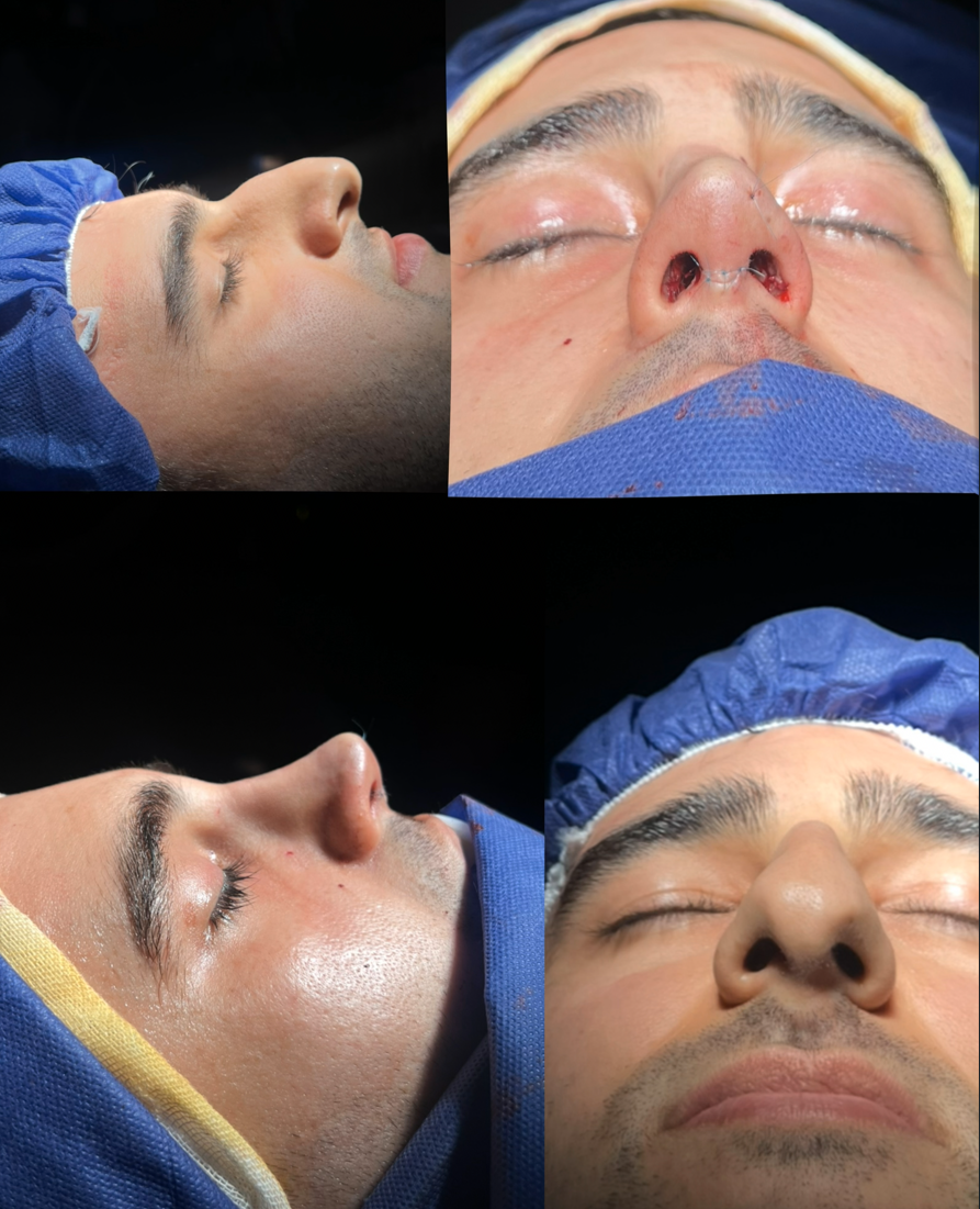 جراحی بینی مردانه عقابی