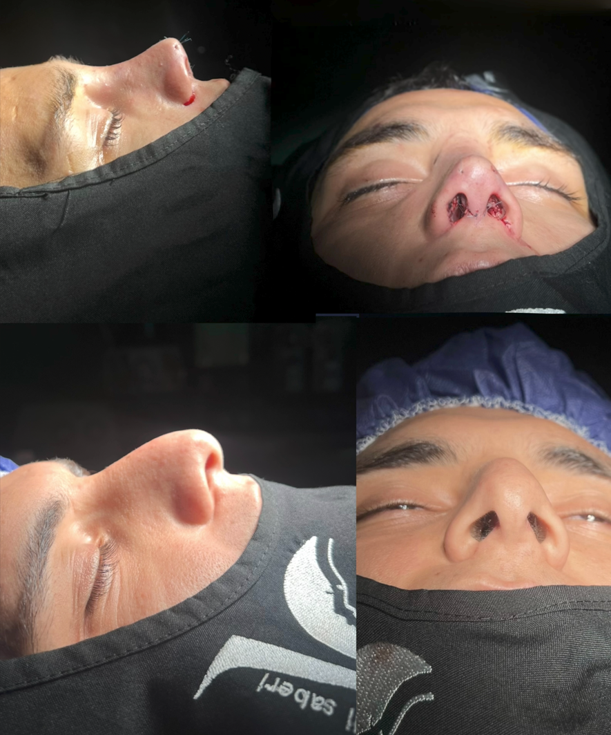 عمل بینی مردانه گوشتی